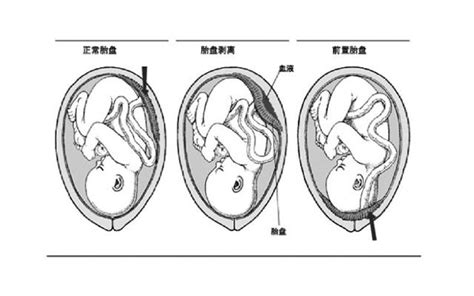 胎盤後壁